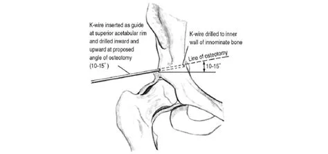A Kirshner wire or Steinmann pin is inserted as a guide at the middle ...