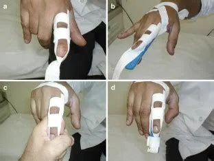 The use of traction splint in the management of phalangeal fractures of ...