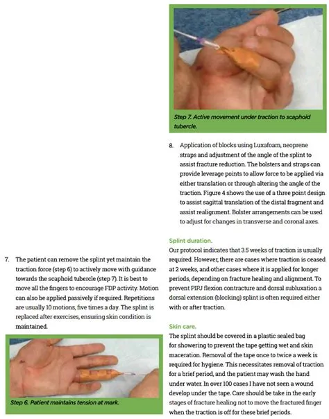 Traction splinting (EAVAST protocol) versus operative fixation of ...