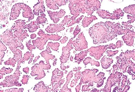 （指南）5th WHO胸部肿瘤-肺乳头状腺瘤-尖端生物科技