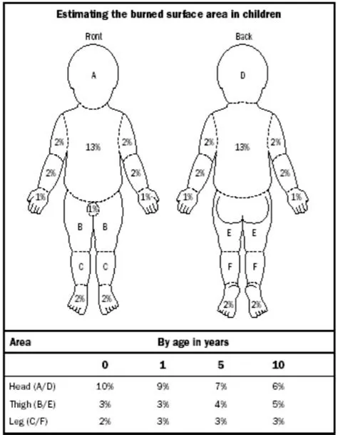 burns in children - Public Health Notes