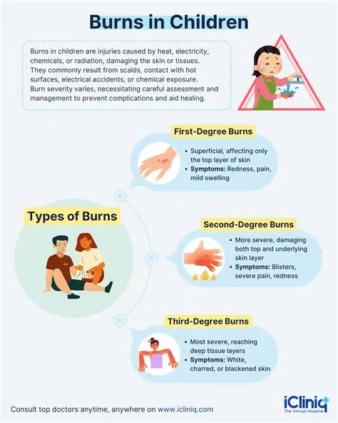 What Is the Management of Burns in Children?