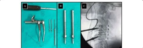 Caspar cervical distractor system (A), Caspar cervical pins (B), The ...