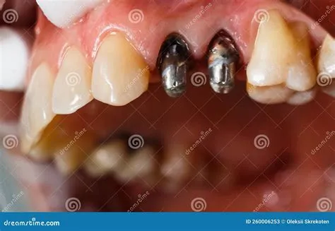 Teeth Drawing Pins at Carl Eason blog