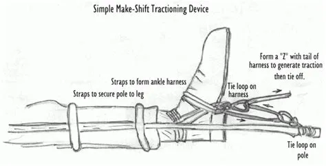 Femoral traction splints, helpful or not? • LITFL • EBM Gone Wild
