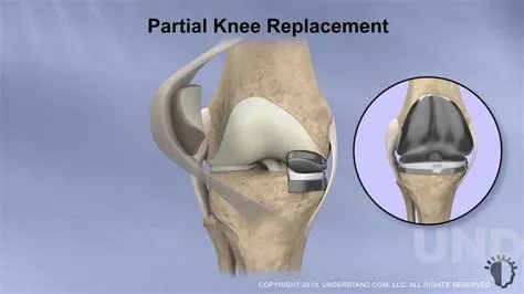 Sports After Partial Knee Replacement at Sybil Downing blog