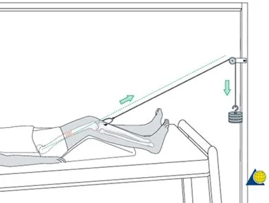Traction for paediatric orthopaedic patients at Starship
