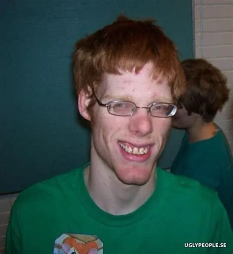 (Garçon) - Avoir acné = Beau , Ne jamais avoir eu d'acné = moche sur le ...