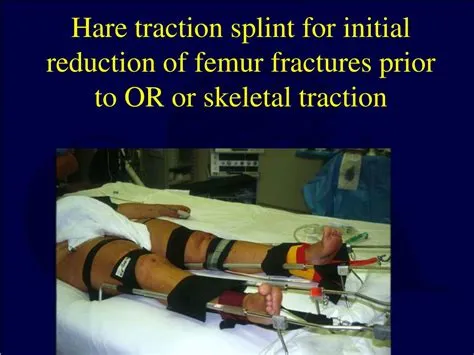 Splint For Femur Fracture at Monte Stock blog