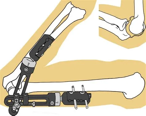 D After removal of the distraction fixator and the fixator pins in the ...