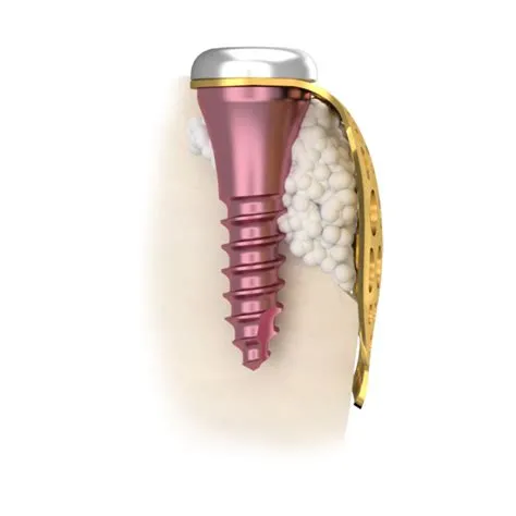 Membrane Fixation Screw