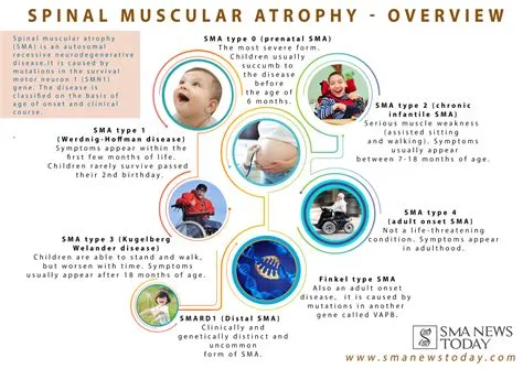 While most types of SMA typically affect children from birth, there are ...