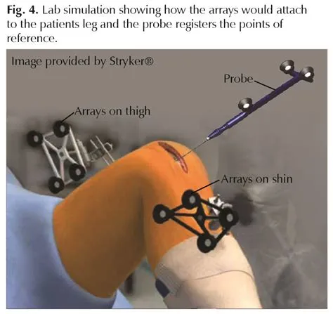 Robotic Total Knee Replacement: Questions for a Specialist - Hughston ...