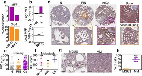 MFF overexpression in cancer. (a) Amplification of MFF and Drp1 in ...