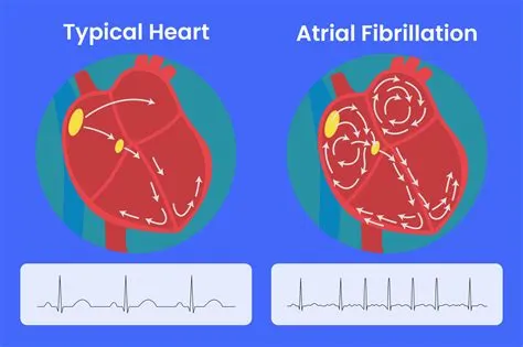 What Does Atrial Fibrillation Feel Like? Understanding the Symptoms