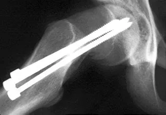 Orthopedic Hardware | Department of Radiology