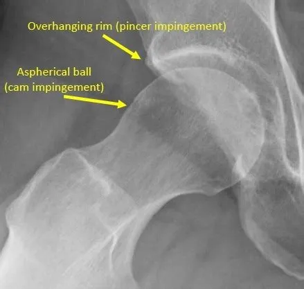 Femoroacetabular Impingement - Di Nallo Orthopaedics