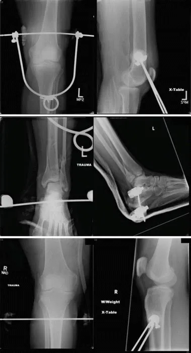 Traction Pin Placement | SpringerLink