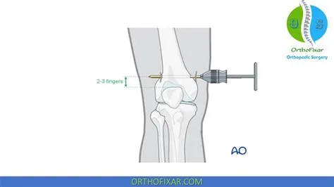 Skeletal Traction Pin Site Care
