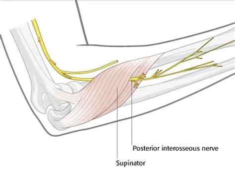 Posterior Interosseous Nerve: Injury to The Incarcerated forearm - Dr ...