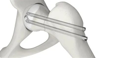 Hansson Pin System - Swemac