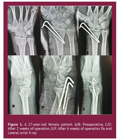 Early Radiological Evaluation of Distal Radius Fractures Treated by ...