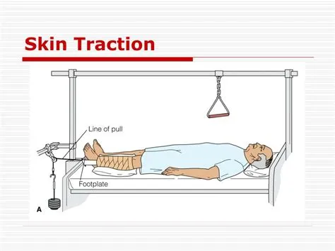 Objective Of Skeletal Traction at Martha Cannon blog