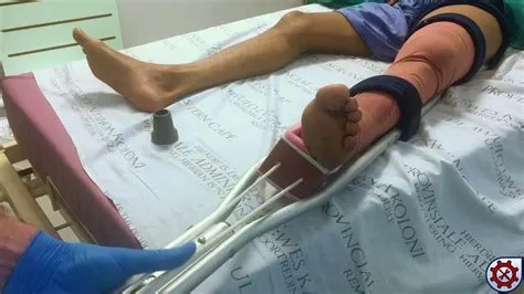 Splint For Femur Fracture at Monte Stock blog