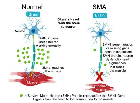 SMA – newbornscreening.info
