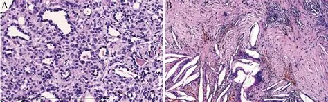 （指南）5th WHO胸部肿瘤-硬化性肺细胞瘤-尖端生物科技