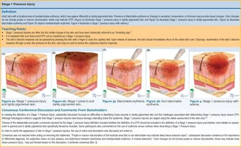 Revised National Pressure Ulcer Advisory Panel Pressure Injury Staging ...
