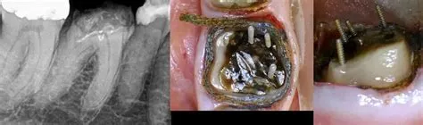 Dental pins for crowns and fillings- Dental code - Bauer Smiles