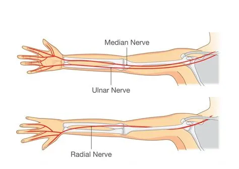 Management of Pins and Needles and Numbness in the Upper Limbs and ...